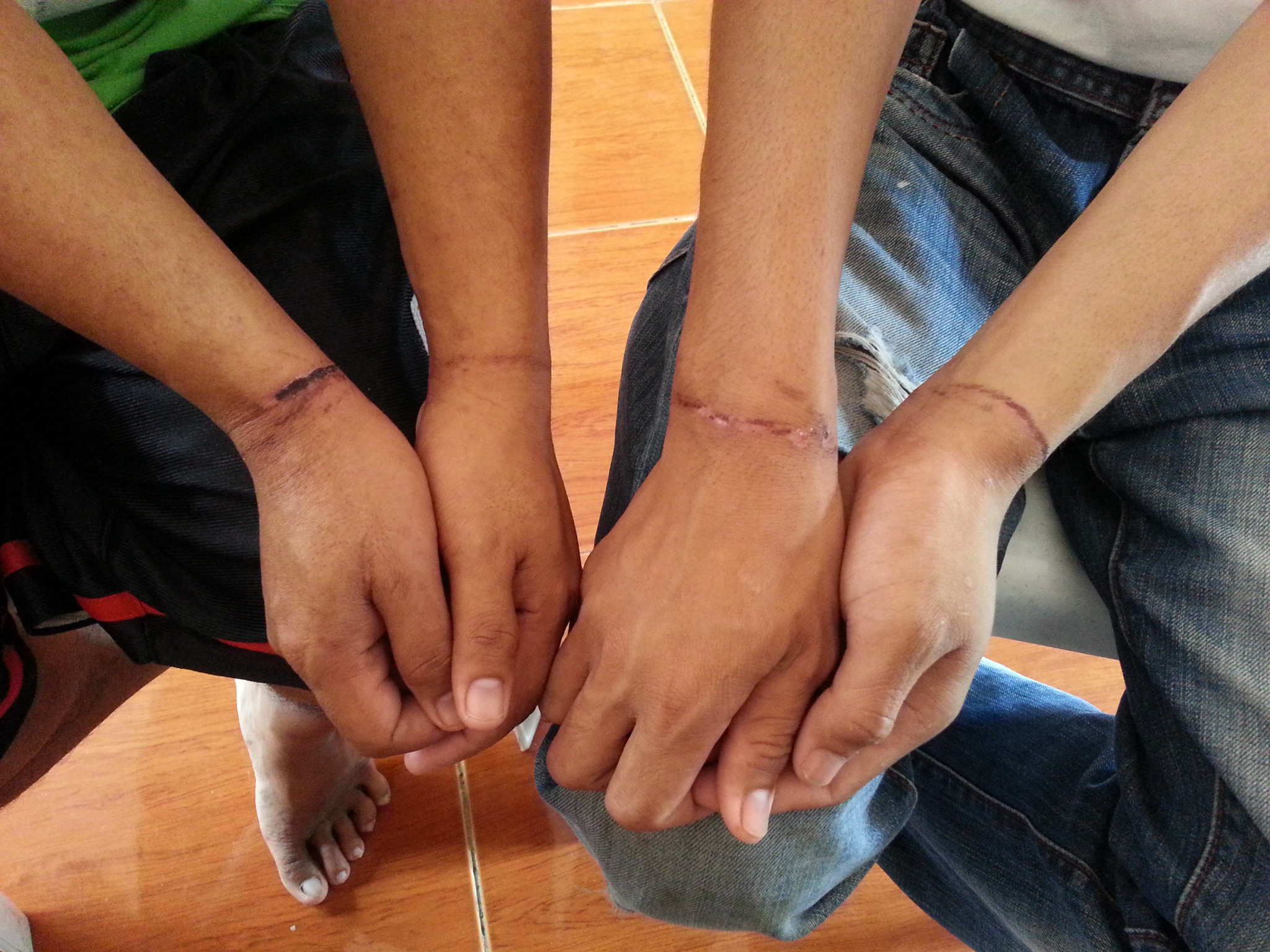 Two teenage minors show their wounded wrists sustained while being held in detention by authorities who claimed they are Moro National Liberation Front rebels. (photo courtesy of Human Rights Watch)