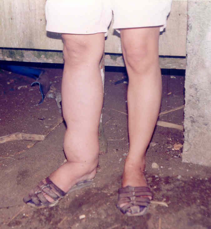 You are currently viewing Filariasis immunization goes to Davao City hinterland