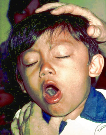 DOH-XI: Protect children from Diphtheria